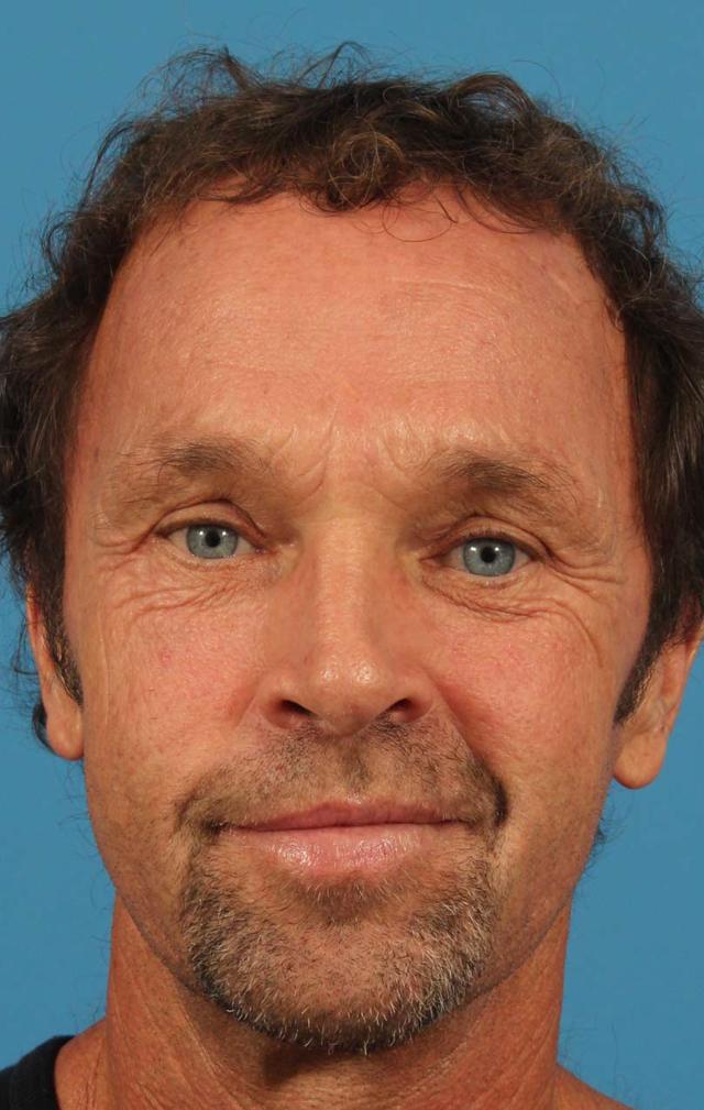Brow Lift after at CARE Plastic Surgery in Cary, NC