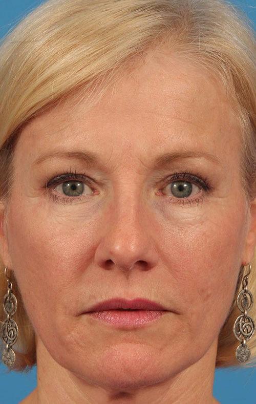 Brow Lift after at CARE Plastic Surgery in Cary, NC