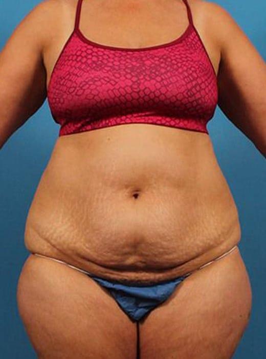 Mini Tummy Tuck before at CARE Plastic Surgery in Cary, NC