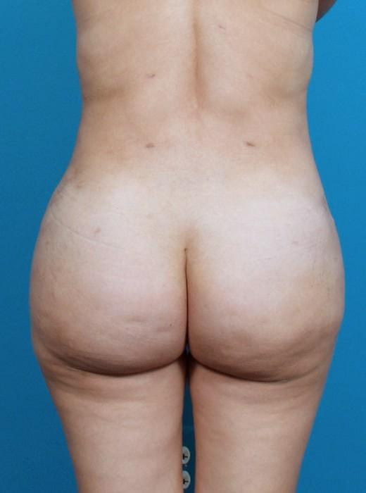 Brazilian Butt Lift after at CARE Plastic Surgery in Cary, NC