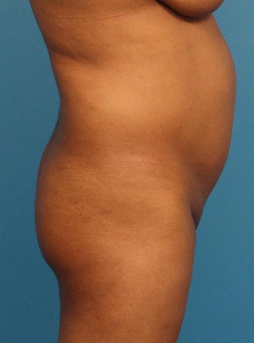 Brazilian Butt Lift before at CARE Plastic Surgery in Cary, NC