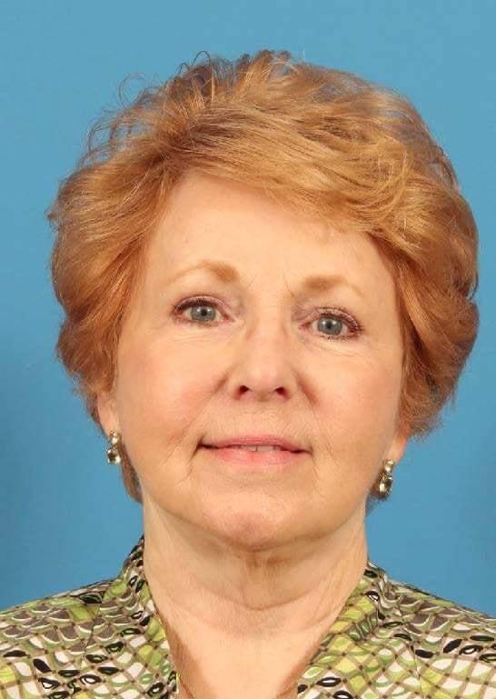 Neck Lift after at CARE Plastic Surgery in Cary, NC