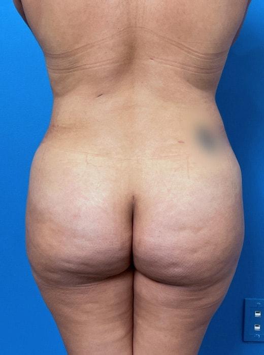 Brazilian Butt Lift after at CARE Plastic Surgery in Cary, NC