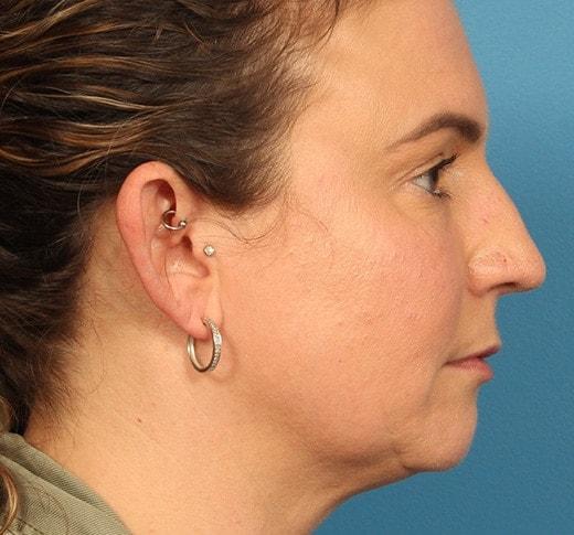 Functional Rhinoplasty before at CARE Plastic Surgery in Cary, NC