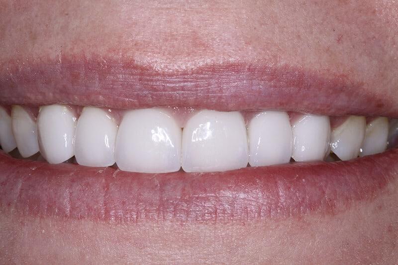 Belmont Dentistry Scottsdale veneers after — Scottsdale, AZ