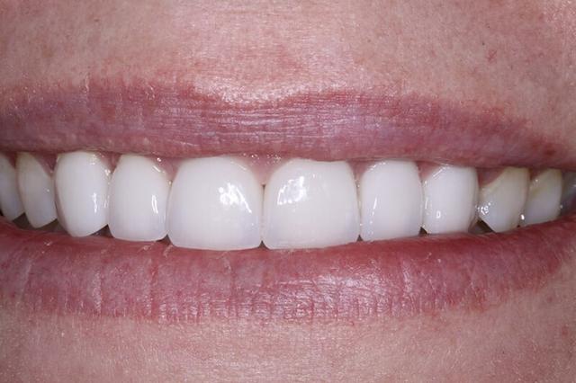 Dental Veneers after at Belmont Dentistry Scottsdale in Scottsdale, AZ