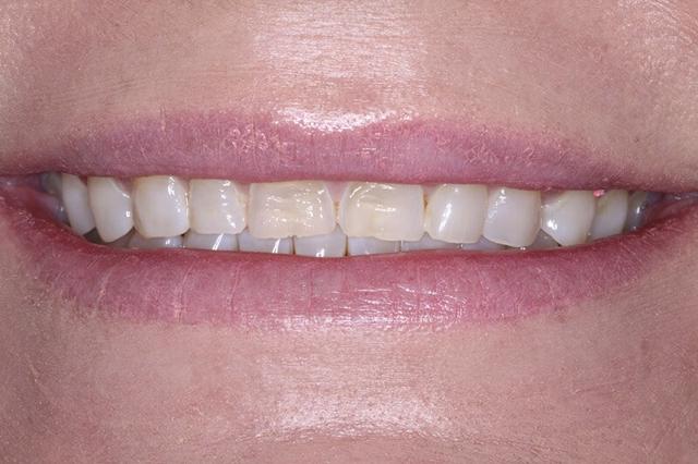 Dental Veneers before at Belmont Dentistry Scottsdale in Scottsdale, AZ
