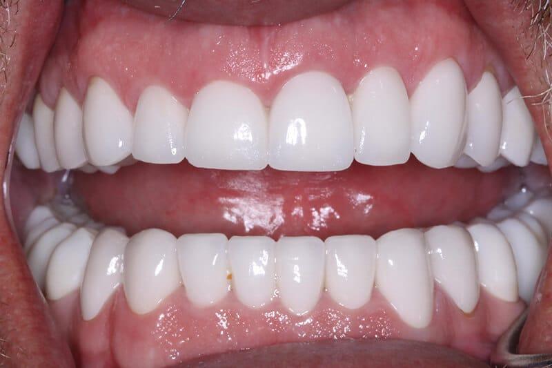Belmont Dentistry Scottsdale smile makeover after — Scottsdale, AZ