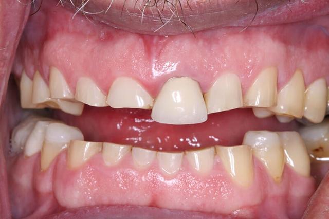 Smile Makeover before at Belmont Dentistry Scottsdale in Scottsdale, AZ