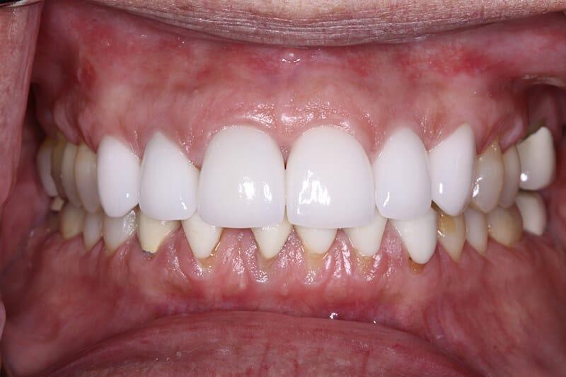 Belmont Dentistry Scottsdale invisalign after — Scottsdale, AZ
