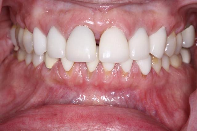 Invisalign before at Belmont Dentistry Scottsdale in Scottsdale, AZ
