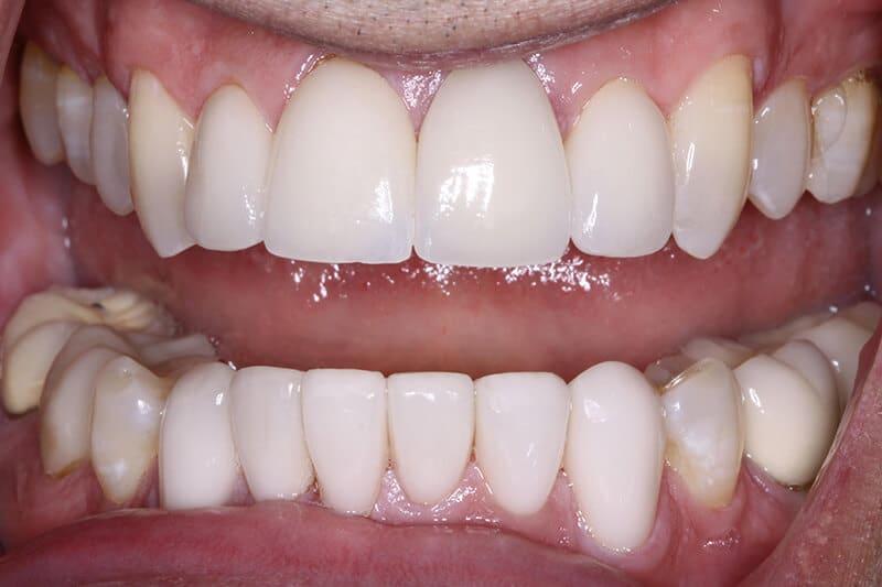 Belmont Dentistry Scottsdale invisalign after — Scottsdale, AZ