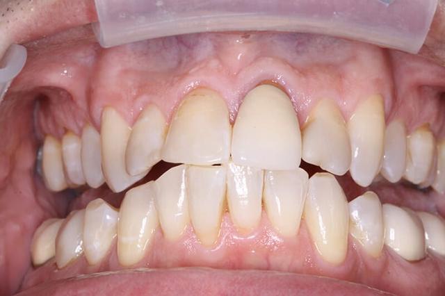 Invisalign before at Belmont Dentistry Scottsdale in Scottsdale, AZ