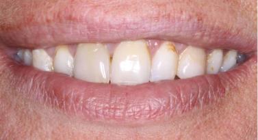 Gum Contouring before at Belmont Dentistry Scottsdale in Scottsdale, AZ