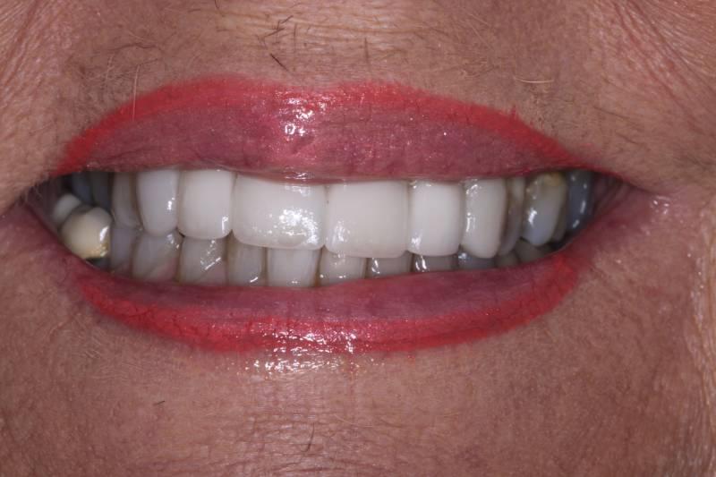 Belmont Dentistry Scottsdale dental implants after — Scottsdale, AZ