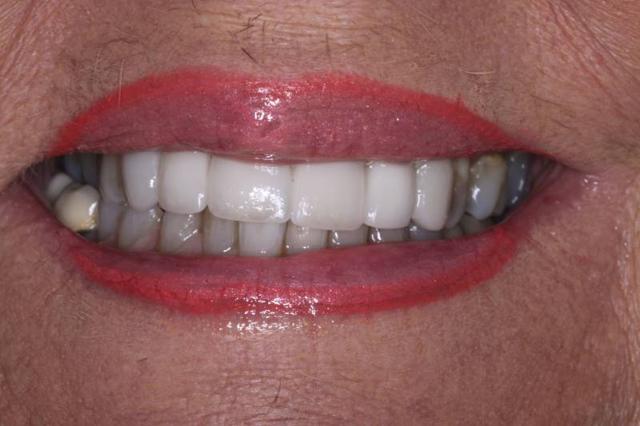Dental Implants after at Belmont Dentistry Scottsdale in Scottsdale, AZ