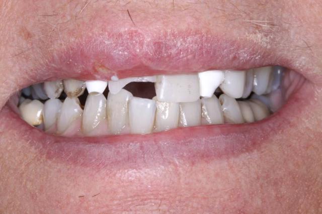 Dental Implants before at Belmont Dentistry Scottsdale in Scottsdale, AZ