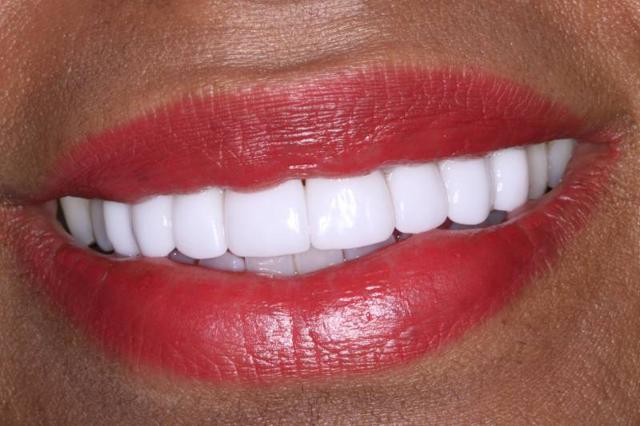Dental Veneers after at Belmont Dentistry Scottsdale in Scottsdale, AZ