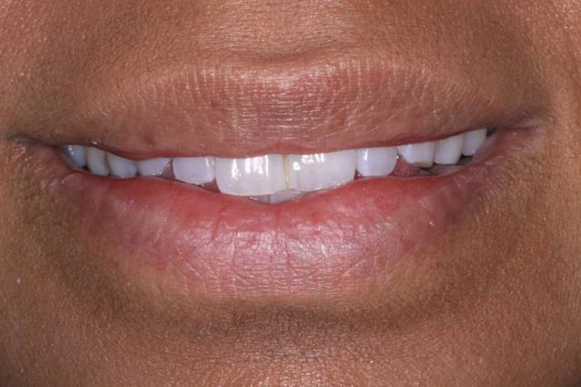 Dental Veneers before at Belmont Dentistry Scottsdale in Scottsdale, AZ