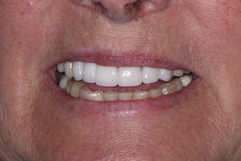 Belmont Dentistry Scottsdale dental implants after — Scottsdale, AZ
