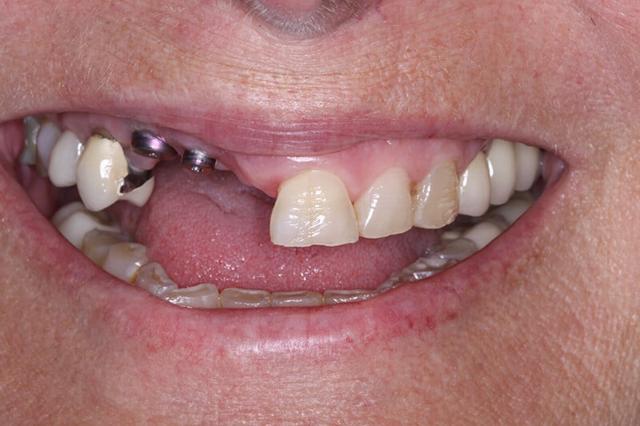 Dental Implants before at Belmont Dentistry Scottsdale in Scottsdale, AZ