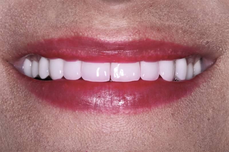 Belmont Dentistry Scottsdale veneers after — Scottsdale, AZ