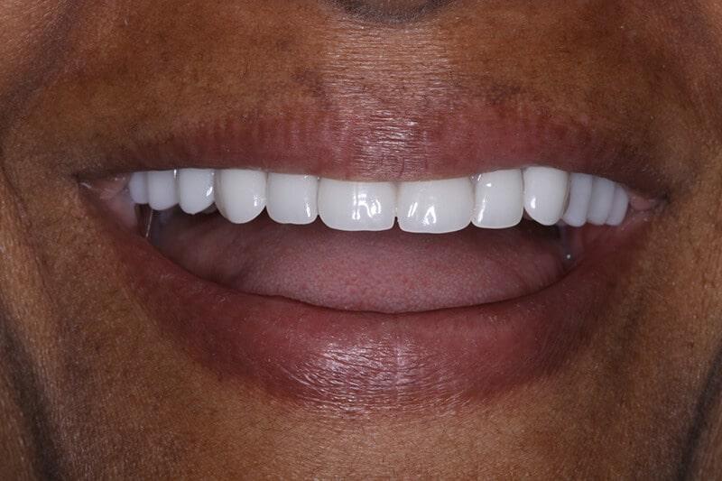 Belmont Dentistry Scottsdale veneers after — Scottsdale, AZ