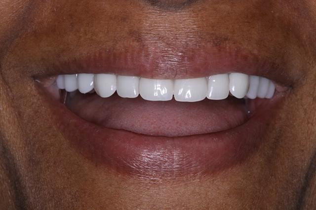 Dental Veneers after at Belmont Dentistry Scottsdale in Scottsdale, AZ