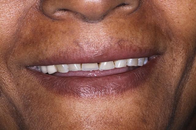 Dental Veneers before at Belmont Dentistry Scottsdale in Scottsdale, AZ