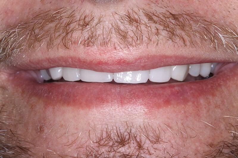 Belmont Dentistry Scottsdale veneers after — Scottsdale, AZ