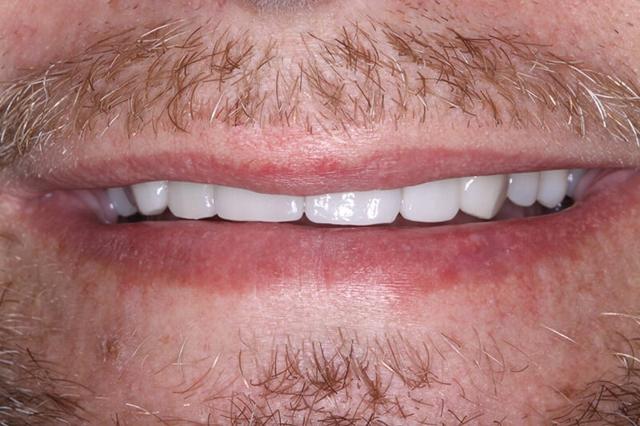 Dental Veneers after at Belmont Dentistry Scottsdale in Scottsdale, AZ