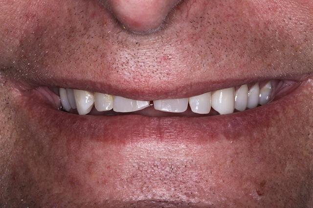 Dental Veneers before at Belmont Dentistry Scottsdale in Scottsdale, AZ