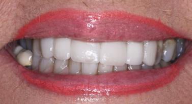 Belmont Dentistry Scottsdale dental implants after — Scottsdale, AZ