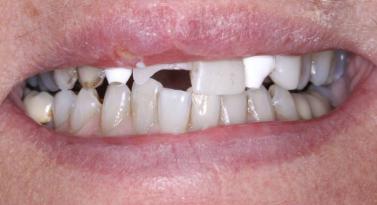 Dental Implants before at Belmont Dentistry Scottsdale in Scottsdale, AZ