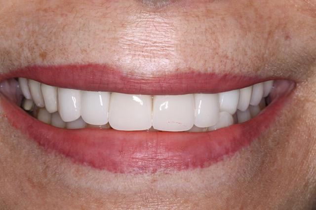 Dental Veneers after at Belmont Dentistry Scottsdale in Scottsdale, AZ