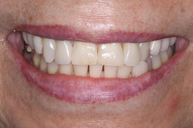Dental Veneers before at Belmont Dentistry Scottsdale in Scottsdale, AZ