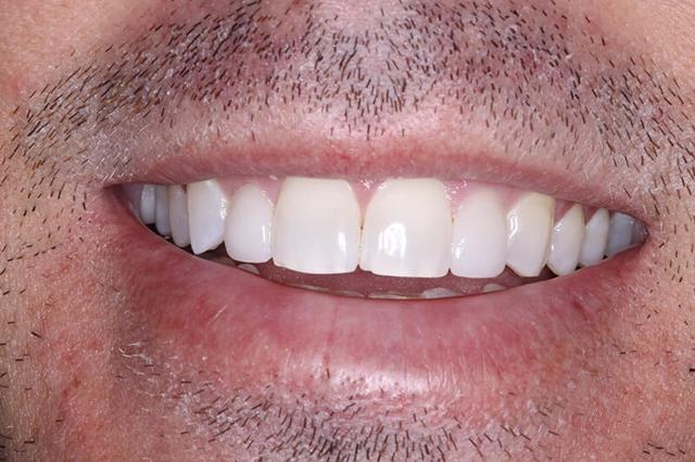 Dental Veneers after at Belmont Dentistry Scottsdale in Scottsdale, AZ