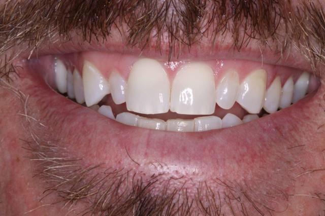 Dental Veneers before at Belmont Dentistry Scottsdale in Scottsdale, AZ