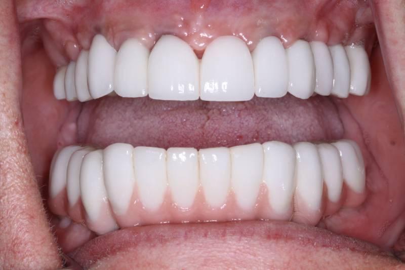 Belmont Dentistry Scottsdale invisalign after — Scottsdale, AZ