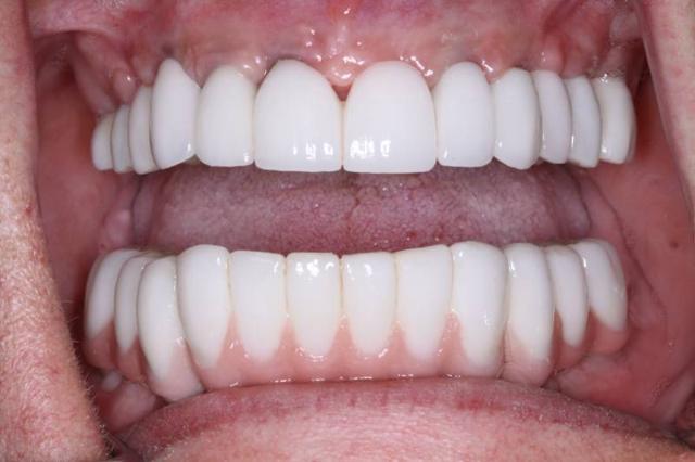 Invisalign after at Belmont Dentistry Scottsdale in Scottsdale, AZ