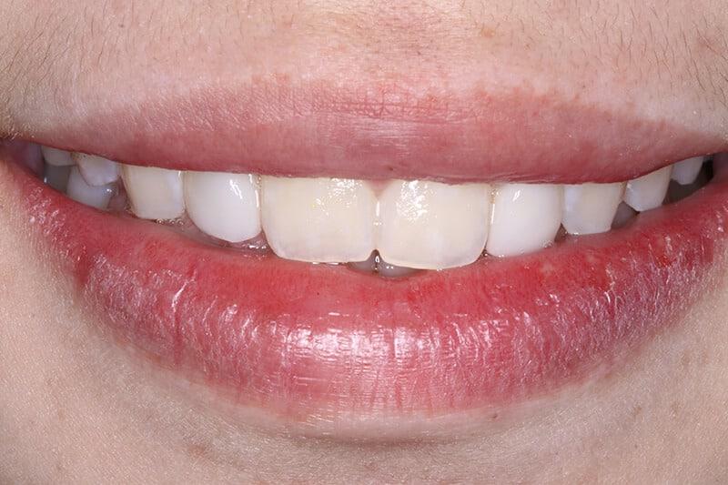 Belmont Dentistry Scottsdale veneers after — Scottsdale, AZ