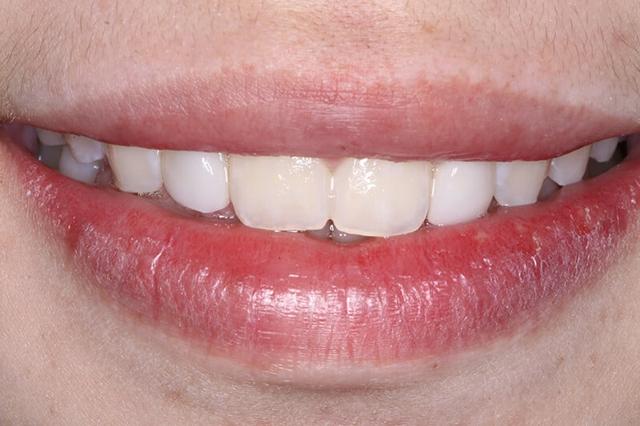 Dental Veneers after at Belmont Dentistry Scottsdale in Scottsdale, AZ