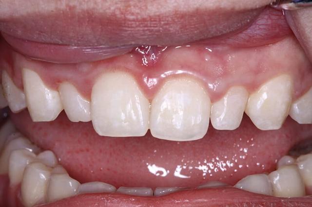 Dental Veneers before at Belmont Dentistry Scottsdale in Scottsdale, AZ