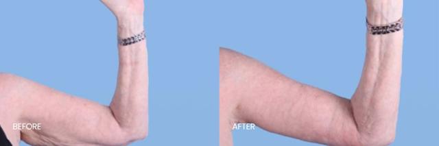 CoolSculpting result at North Texas Plastic Surgery in Dallas, TX