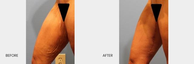 Thigh Lift result at North Texas Plastic Surgery in Dallas, TX