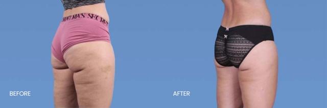CoolSculpting result at North Texas Plastic Surgery in Dallas, TX