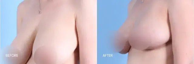 Breast Reduction result at North Texas Plastic Surgery in Dallas, TX