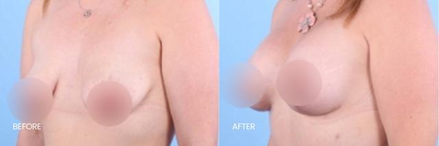 Breast Lift result at North Texas Plastic Surgery in Dallas, TX