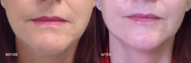 Dermal Fillers result at North Texas Plastic Surgery in Dallas, TX