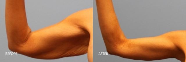 Arm Lift result at North Texas Plastic Surgery in Dallas, TX